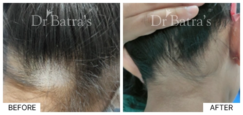 Hair Falling Treatment